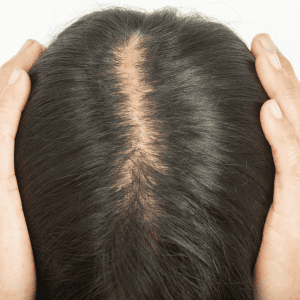 Feature image for an Alopecia & Beyond blog article dated March 18, 2024, titled Understanding Hair Miniaturization. It shows a close-up of the top of a person's head with visible hair thinning, indicative of the hair miniaturization process often linked to hair loss conditions.